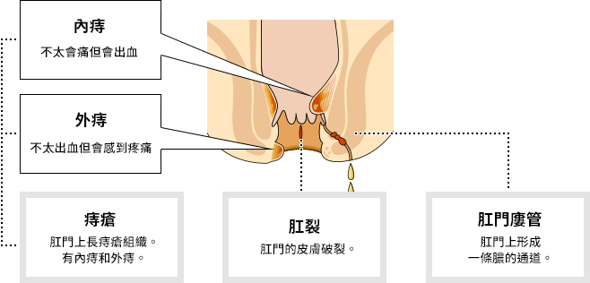 痔瘡大致分為3種