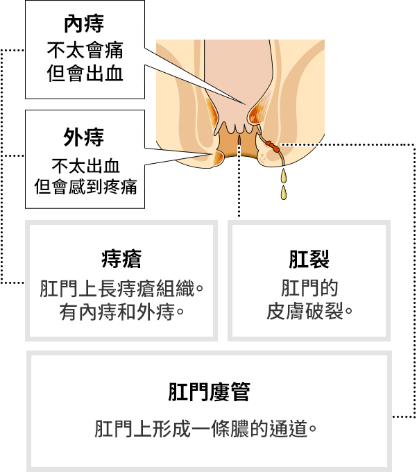 痔瘡大致分為3種