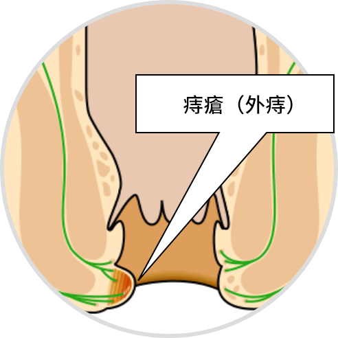 いぼ痔（外痔核）の主な症状